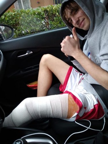 Vigor Basket Matelica : Felipe Franch operato al ginocchio, 6-8 mesi per il rientro